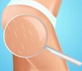 What are the stretch marks and how are you getting rid?